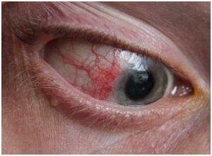 Bệnh vẩy nến và các bệnh đi kèm – Viêm nhiễm về mắt
