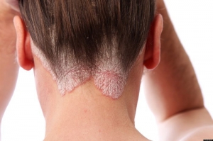 Triệu chứng bệnh vảy nến da đầu – Da liễu Dr Michaels